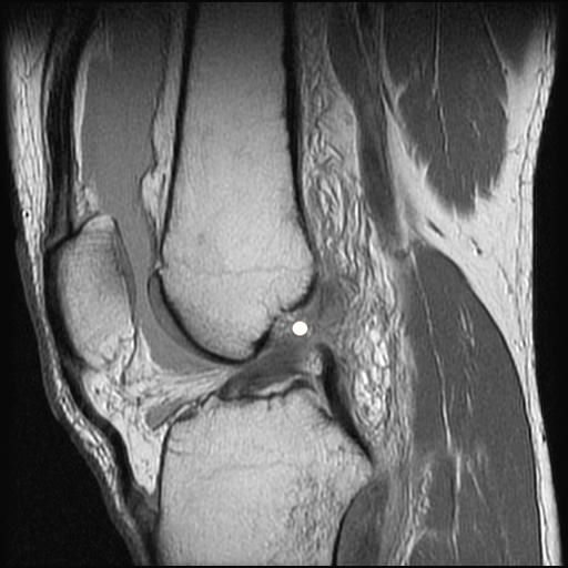 Magnetresonanztomographie (Kernspintomographie) eines vorderen Kreuzbandrisses (mit weissem Punkt markiert)
